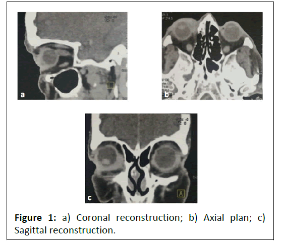 neoplasm-reconstruction