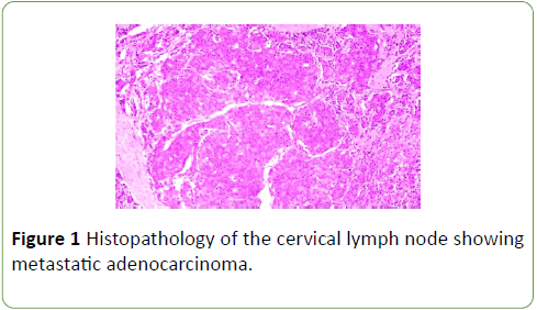 neoplasm-cervical