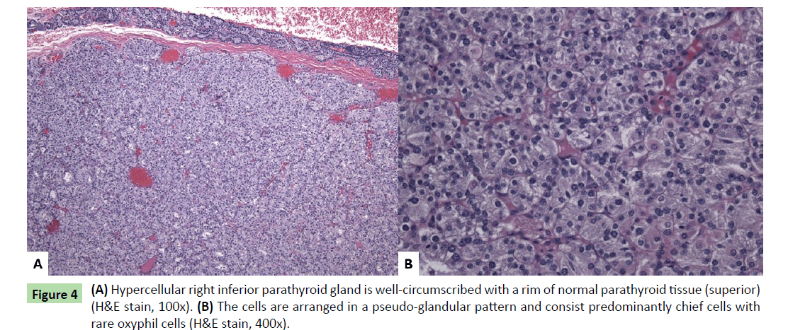 neoplasm-inferior-parathyroid