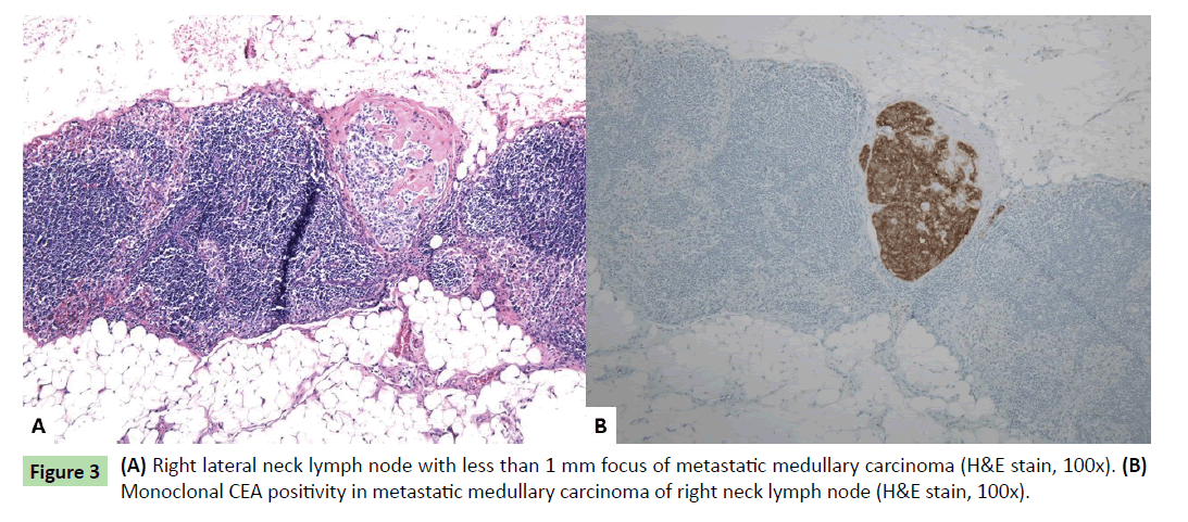 neoplasm-lateral-neck