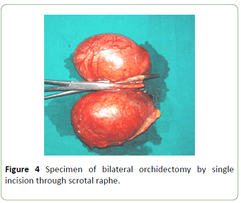 neoplasm-orchidectomy